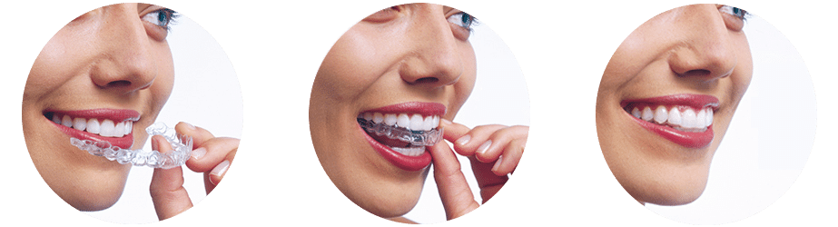 ventajas de invisalign la ortodoncia invisible