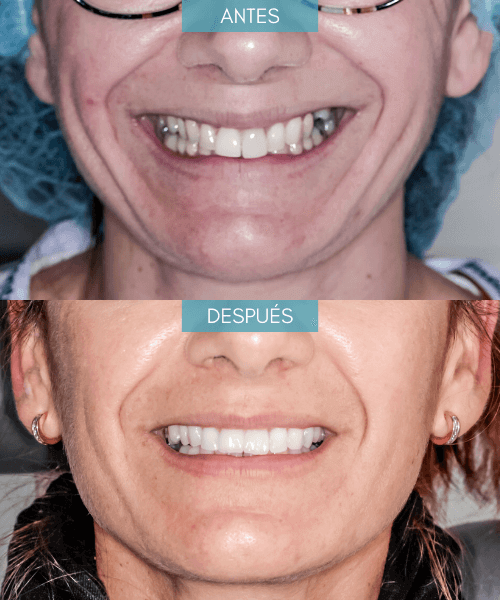 implantes dentales antes y despues