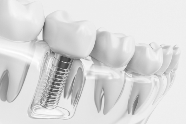 implantes de dientes en brenes